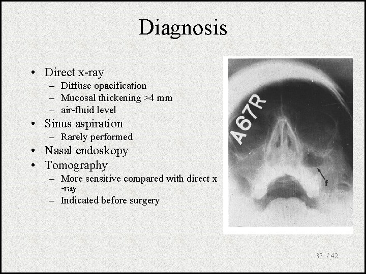 Diagnosis • Direct x-ray – Diffuse opacification – Mucosal thickening >4 mm – air-fluid