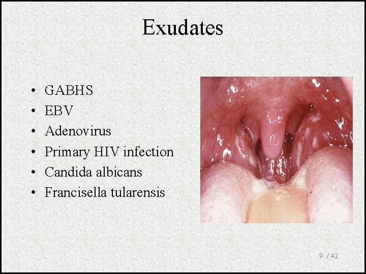 Exudates • • • GABHS EBV Adenovirus Primary HIV infection Candida albicans Francisella tularensis