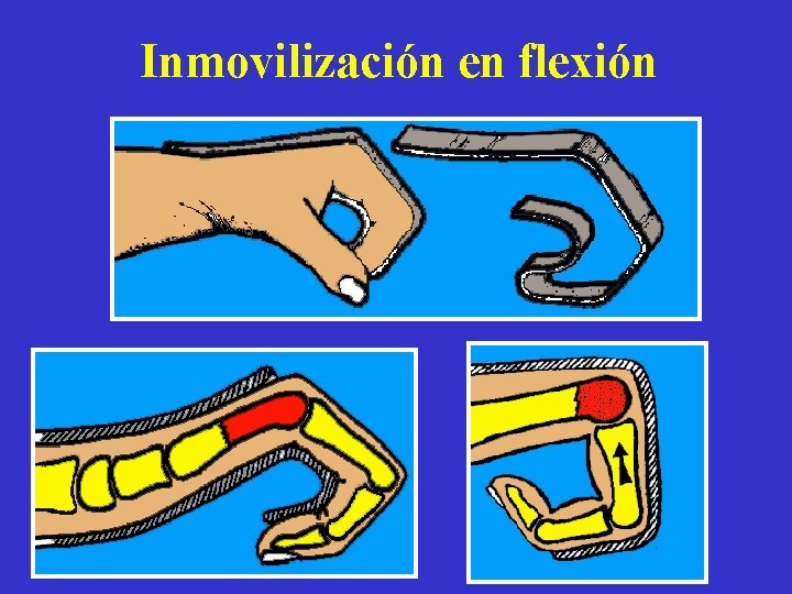 Inmovilización en flexión 