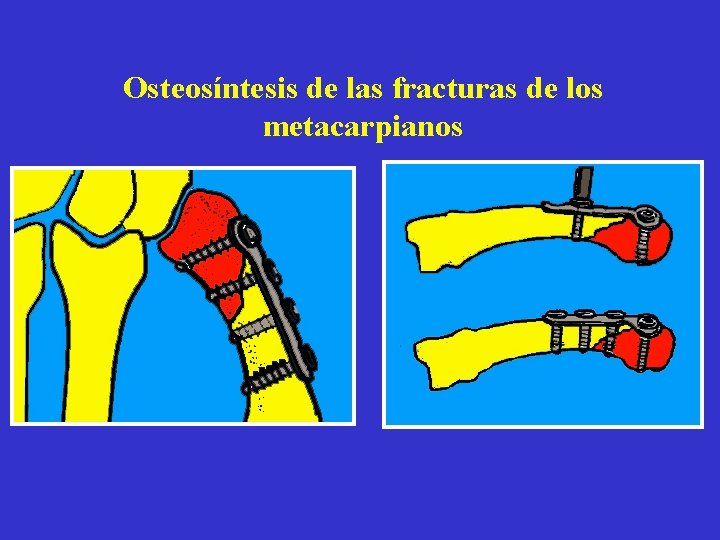 Osteosíntesis de las fracturas de los metacarpianos 