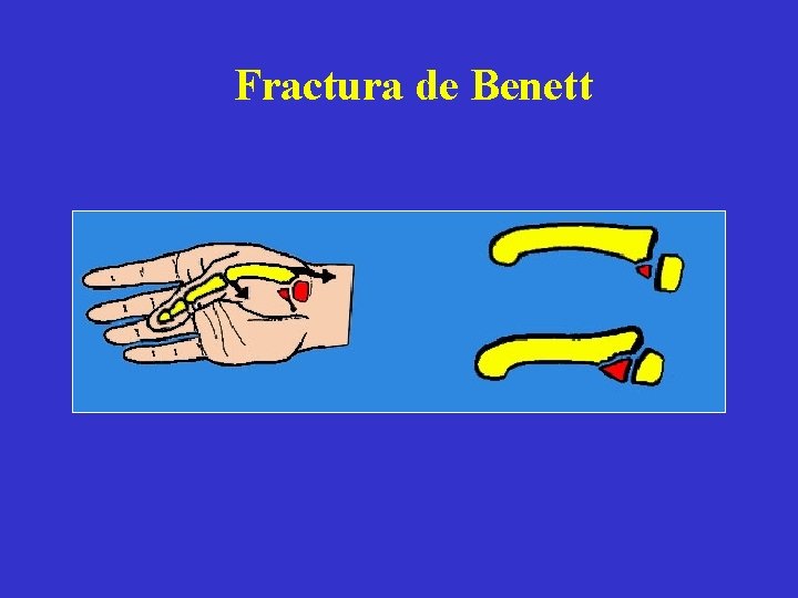 Fractura de Benett Fractura de Benett