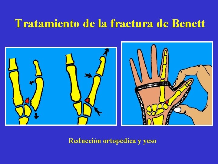 Tratamiento de la fractura de Benett Reducción ortopédica y yeso 