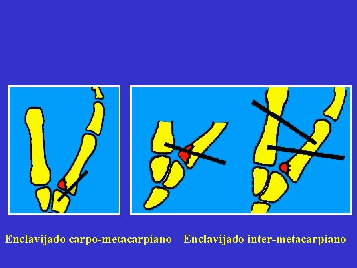 Enclavijado carpo-metacarpiano Enclavijado inter-metacarpiano 