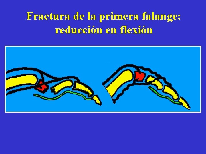 Fractura de la primera falange: reducción en flexión 