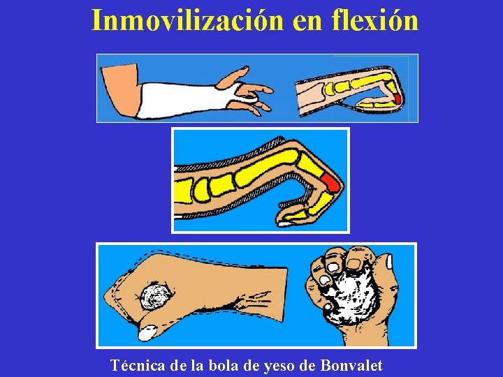 Inmovilización en flexión Técnica de la bola de yeso de Bonvalet 