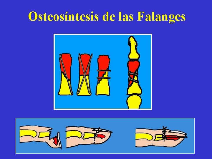 Osteosíntesis de las Falanges 
