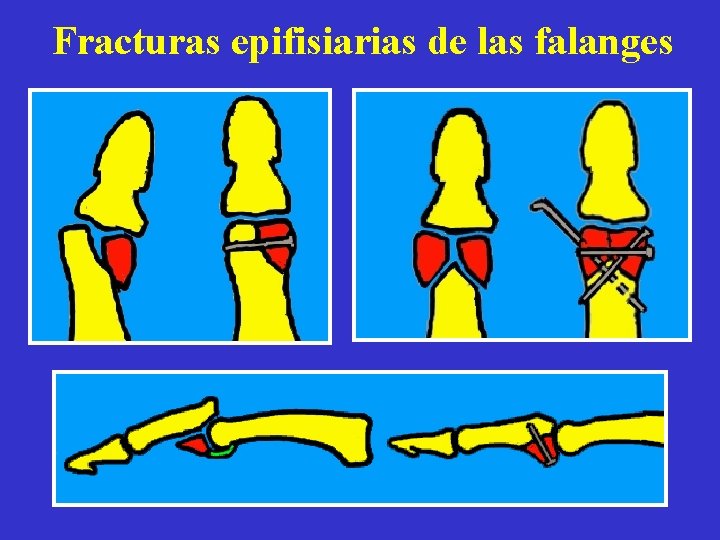 Fracturas epifisiarias de las falanges 