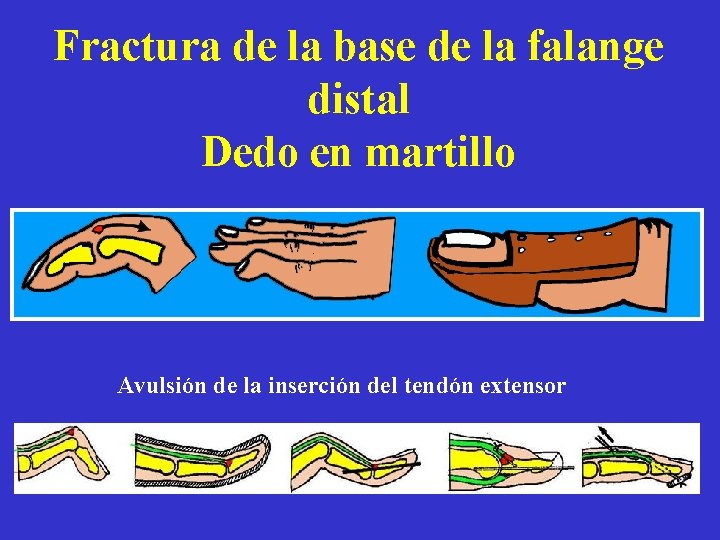 Fractura de la base de la falange distal Dedo en martillo Avulsión de la