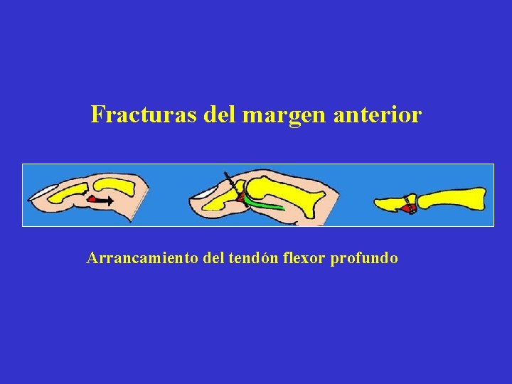 Fracturas del margen anterior Arrancamiento del tendón flexor profundo 