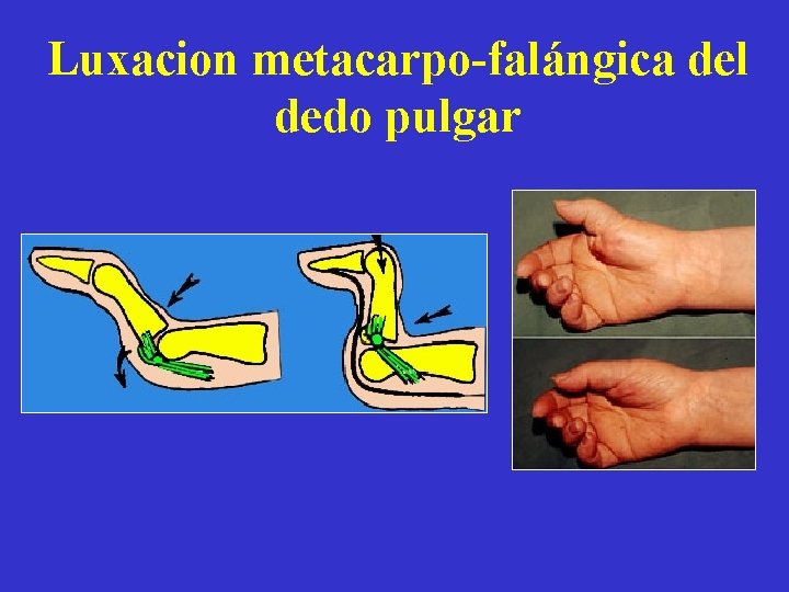 Luxacion metacarpo-falángica del dedo pulgar 