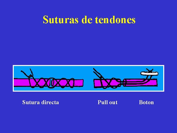 Suturas de tendones Sutura directa Pull out Boton 