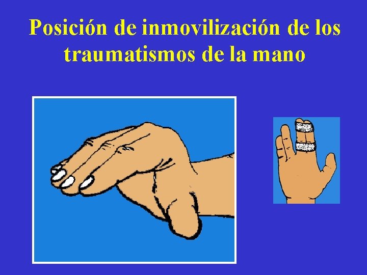 Posición de inmovilización de los traumatismos de la mano 