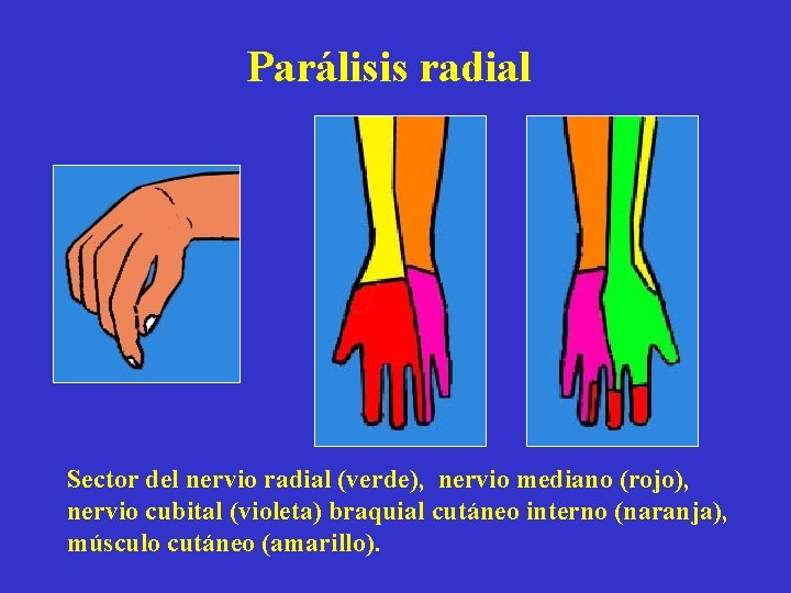 Parálisis radial Sector del nervio radial (verde), nervio mediano (rojo), nervio cubital (violeta) braquial