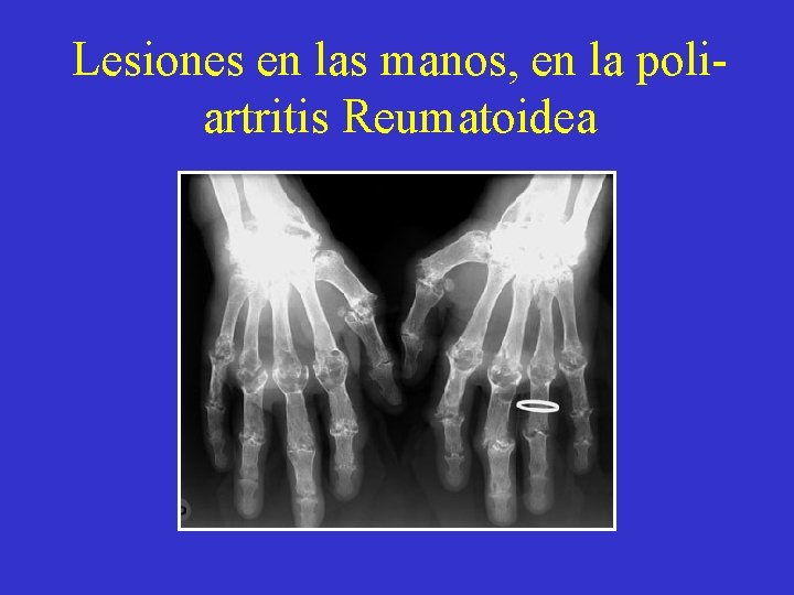 Lesiones en las manos, en la poliartritis Reumatoidea 