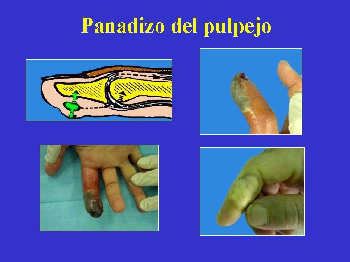 Panadizo del pulpejo 