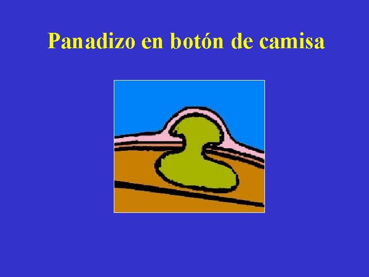 Panadizo en botón de camisa 