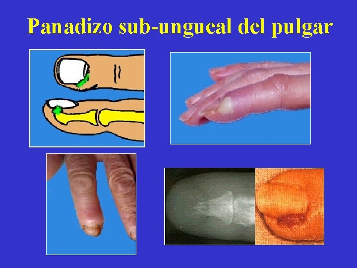 Panadizo sub-ungueal del pulgar 