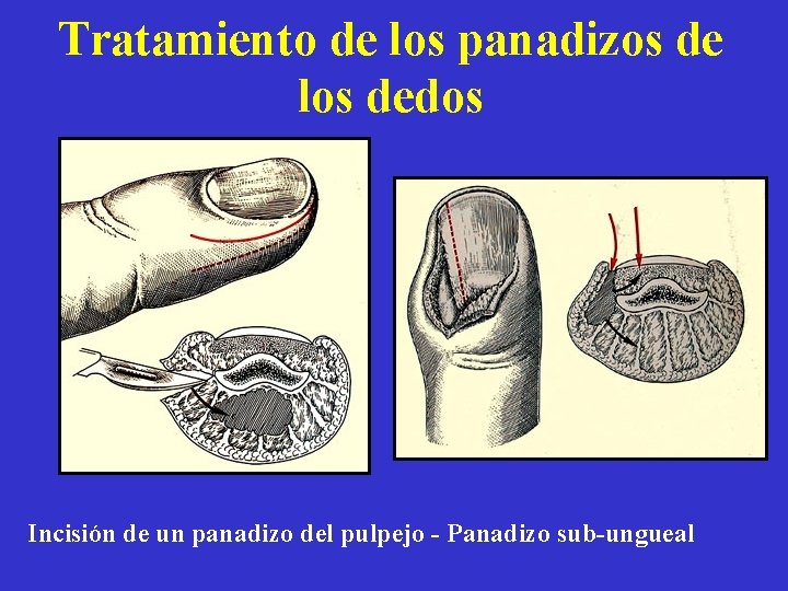 Tratamiento de los panadizos de los dedos Incisión de un panadizo del pulpejo -