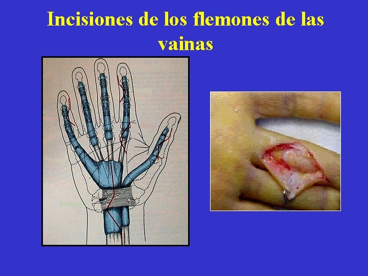 Incisiones de los flemones de las vainas 