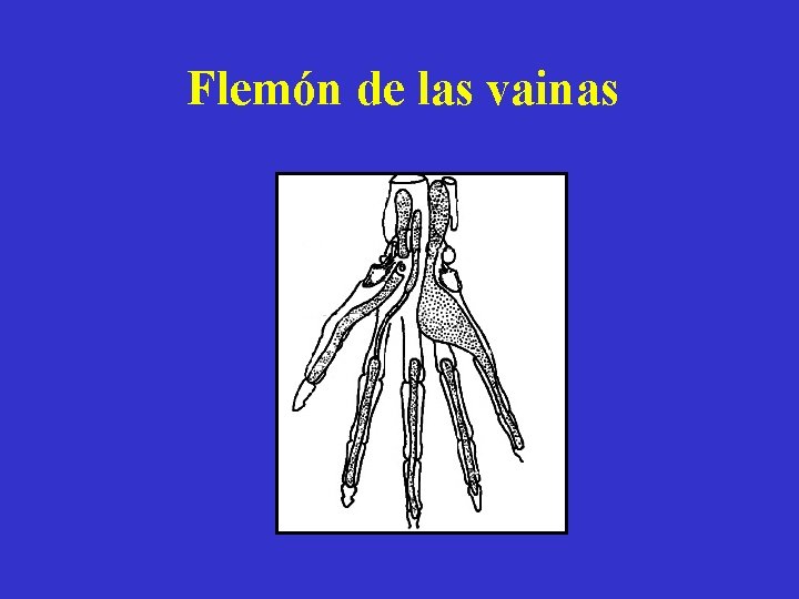 Flemón de las vainas 