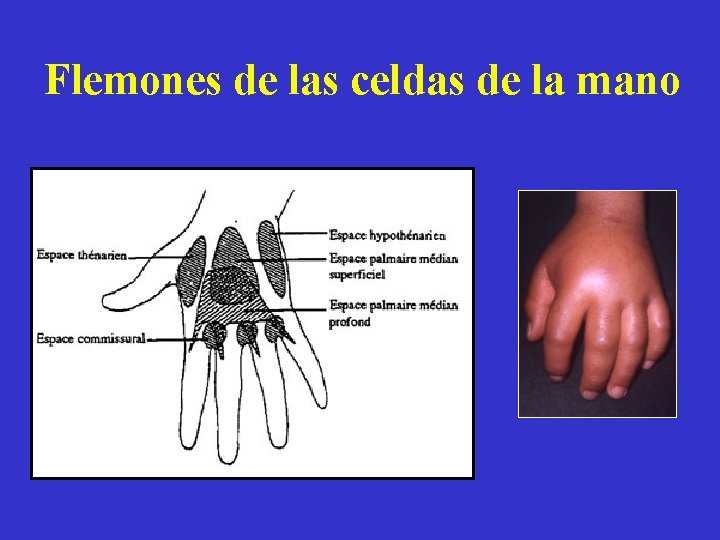 Flemones de las celdas de la mano 