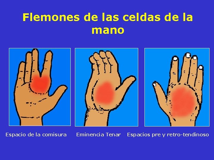 Flemones de las celdas de la mano Espacio de la comisura Eminencia Tenar Espacios