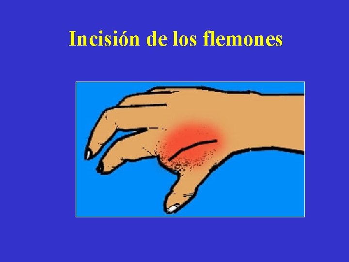 Incisión de los flemones 