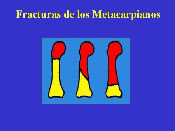 Fracturas de los Metacarpianos 