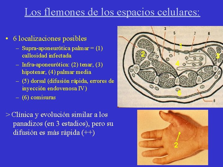 Los flemones de los espacios celulares: • 6 localizaciones posibles – Supra-aponeurótica palmar =