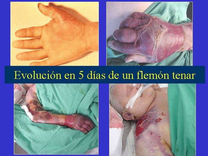 Evolución en 5 días de un flemón tenar 