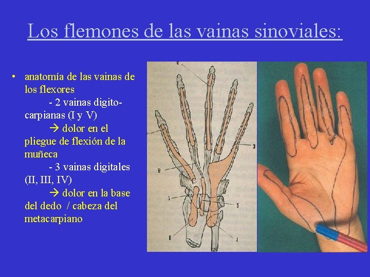 Los flemones de las vainas sinoviales: • anatomía de las vainas de los flexores