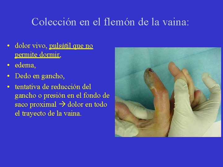 Colección en el flemón de la vaina: • dolor vivo, pulsátil que no permite Colección en el flemón de la vaina: • dolor vivo, pulsátil que no permite
