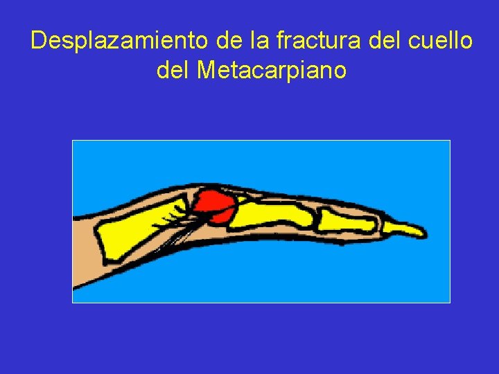 Desplazamiento de la fractura del cuello del Metacarpiano 