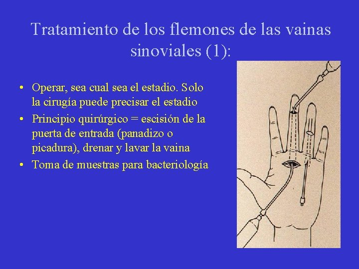 Tratamiento de los flemones de las vainas sinoviales (1): • Operar, sea cual sea