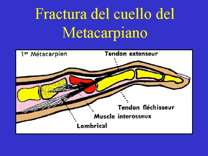 Fractura del cuello del Metacarpiano 