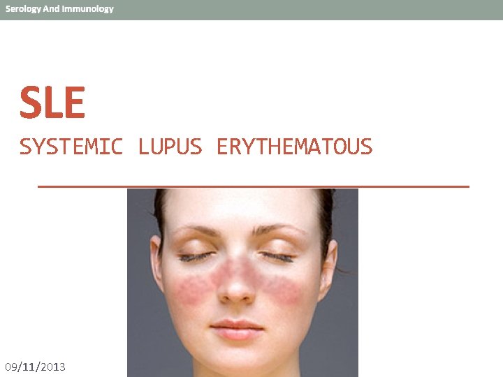 SLE SYSTEMIC LUPUS ERYTHEMATOUS 09/11/2013 