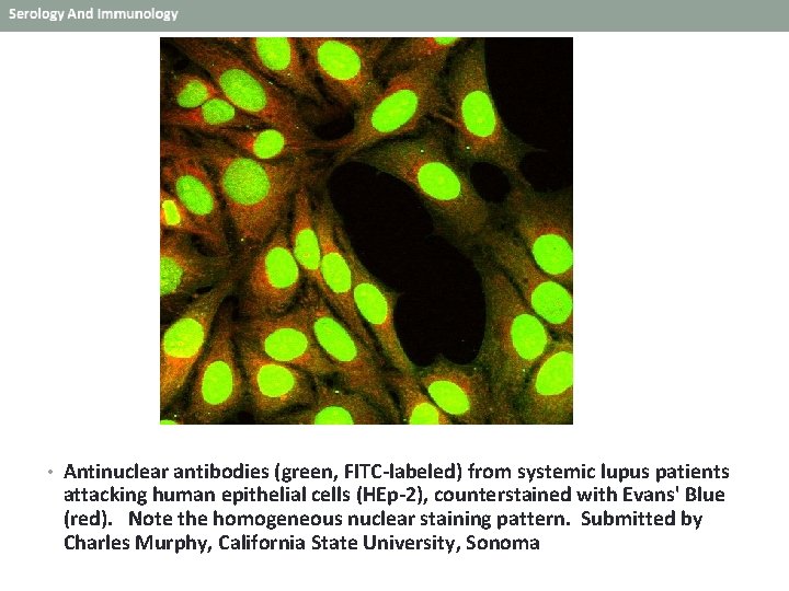  • Antinuclear antibodies (green, FITC-labeled) from systemic lupus patients attacking human epithelial cells
