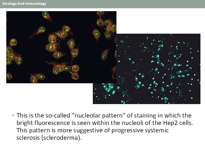  • This is the so-called "nucleolar pattern" of staining in which the bright