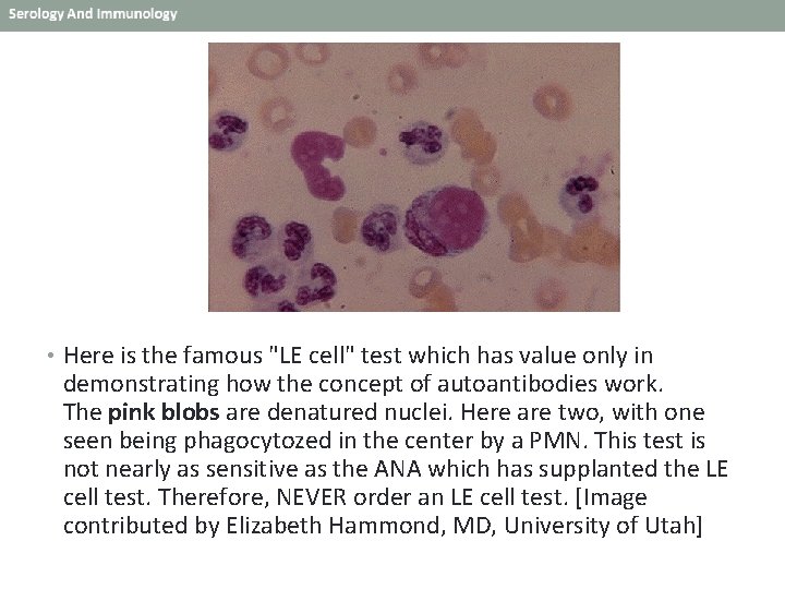  • Here is the famous "LE cell" test which has value only in