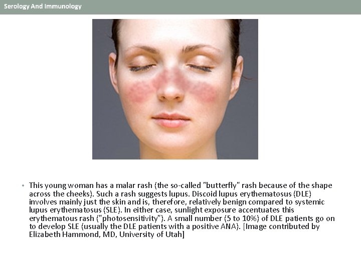  • This young woman has a malar rash (the so-called "butterfly" rash because