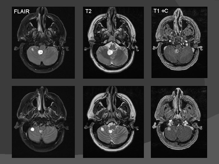 FLAIR T 2 T 1 +C 