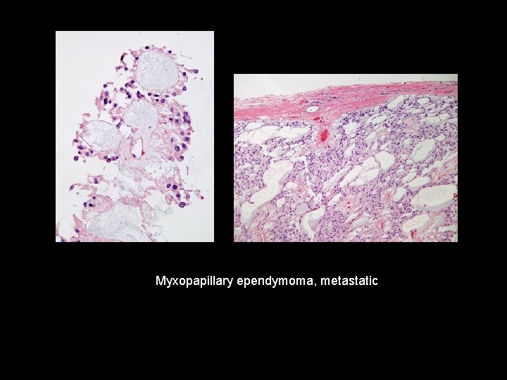 Myxopapillary ependymoma, metastatic 