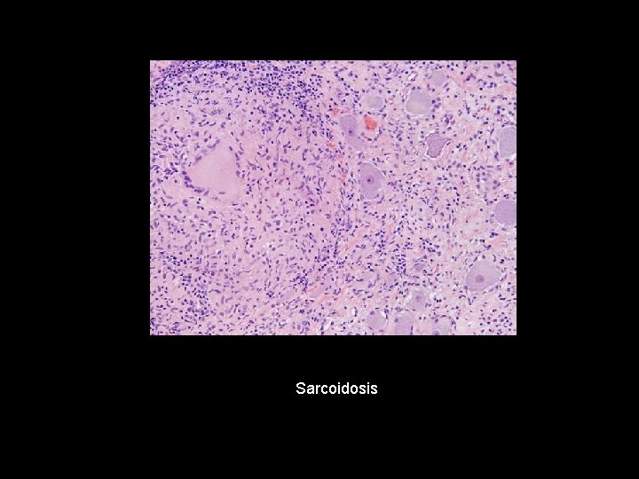 Sarcoidosis 