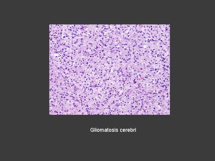 Gliomatosis cerebri 