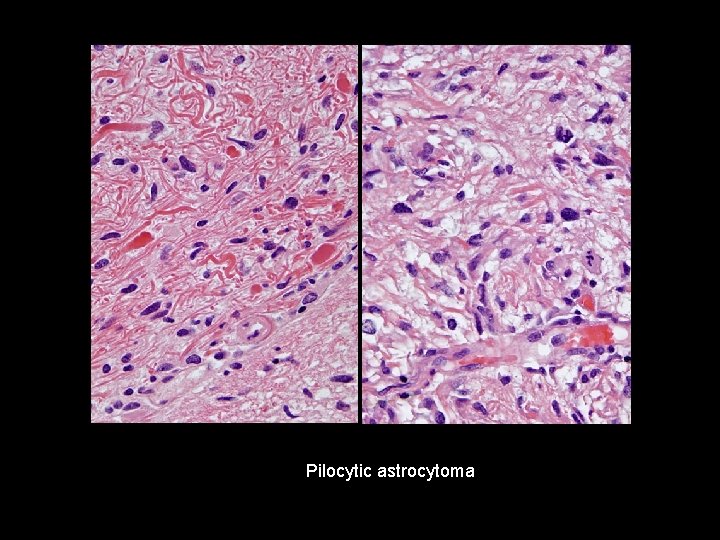 Pilocytic astrocytoma 