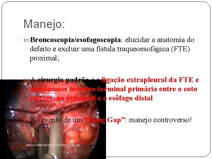 Manejo: Broncoscopia/esofagoscopia: elucidar a anatomia do defeito e excluir uma fístula traqueoesofágica (FTE) proximal;