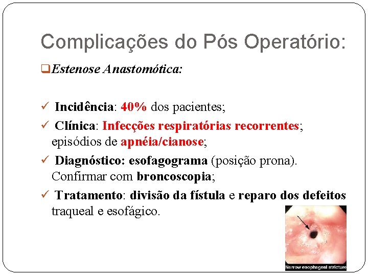 Complicações do Pós Operatório: q Estenose Anastomótica: ü Incidência: 40% dos pacientes; ü Clínica: