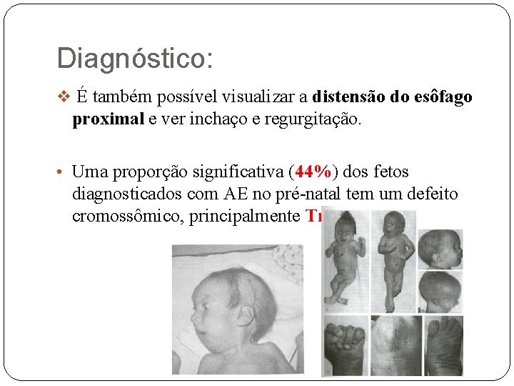 Diagnóstico: v É também possível visualizar a distensão do esôfago proximal e ver inchaço