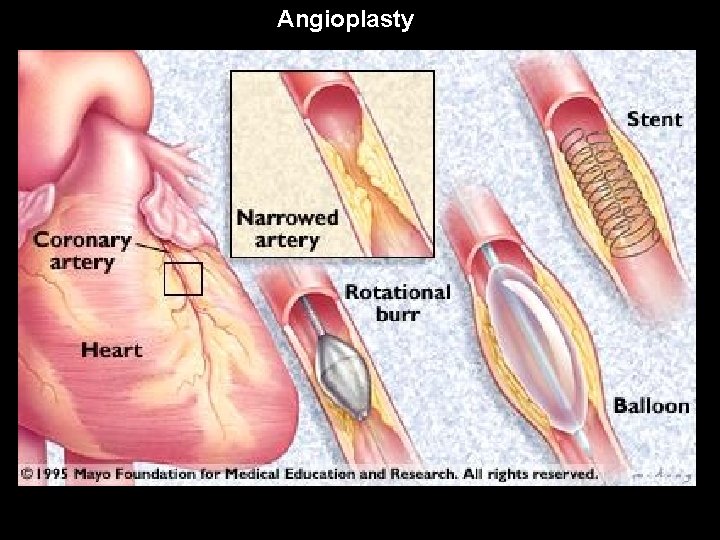 Angioplasty 