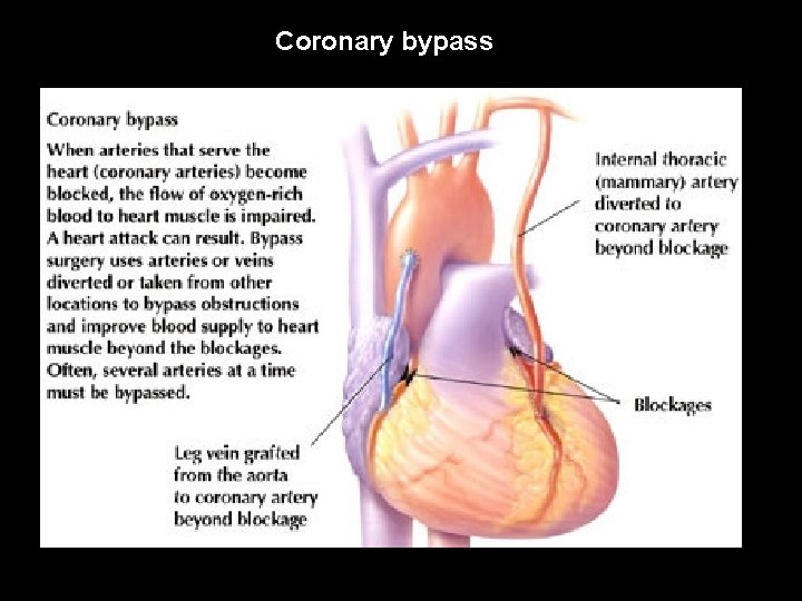 Coronary bypass 
